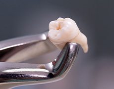 Dental forceps holding an extracted tooth