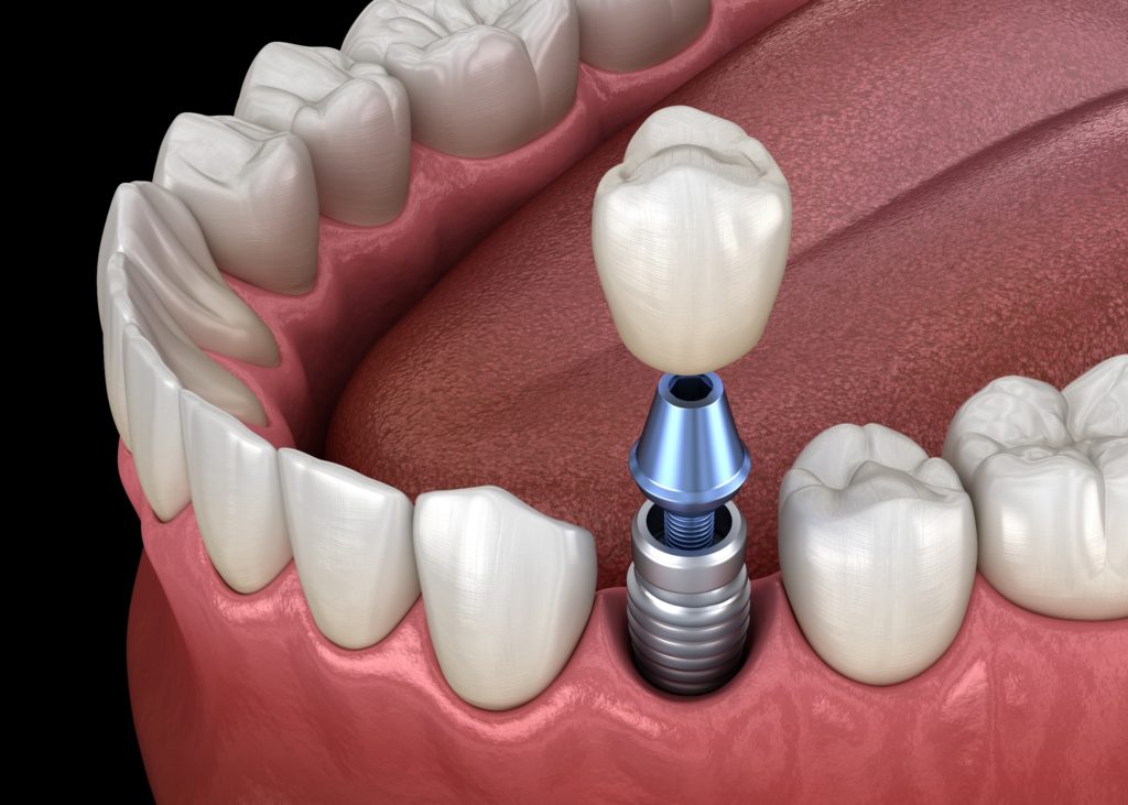 Dental Implant 24 Clear Coast Dental Blog   Dental Implant 24 1024x731 