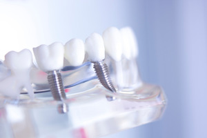 Dental implants in plastic tray with model teeth